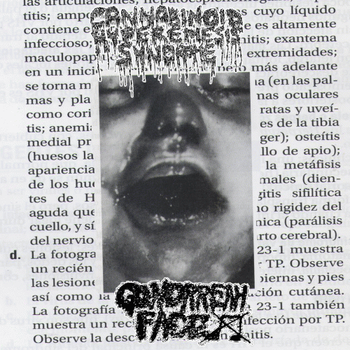 Cannabinoid Hyperemesis Syndrome : Gonorrhea Face - Cannabinoid Hyperemesis Syndrome